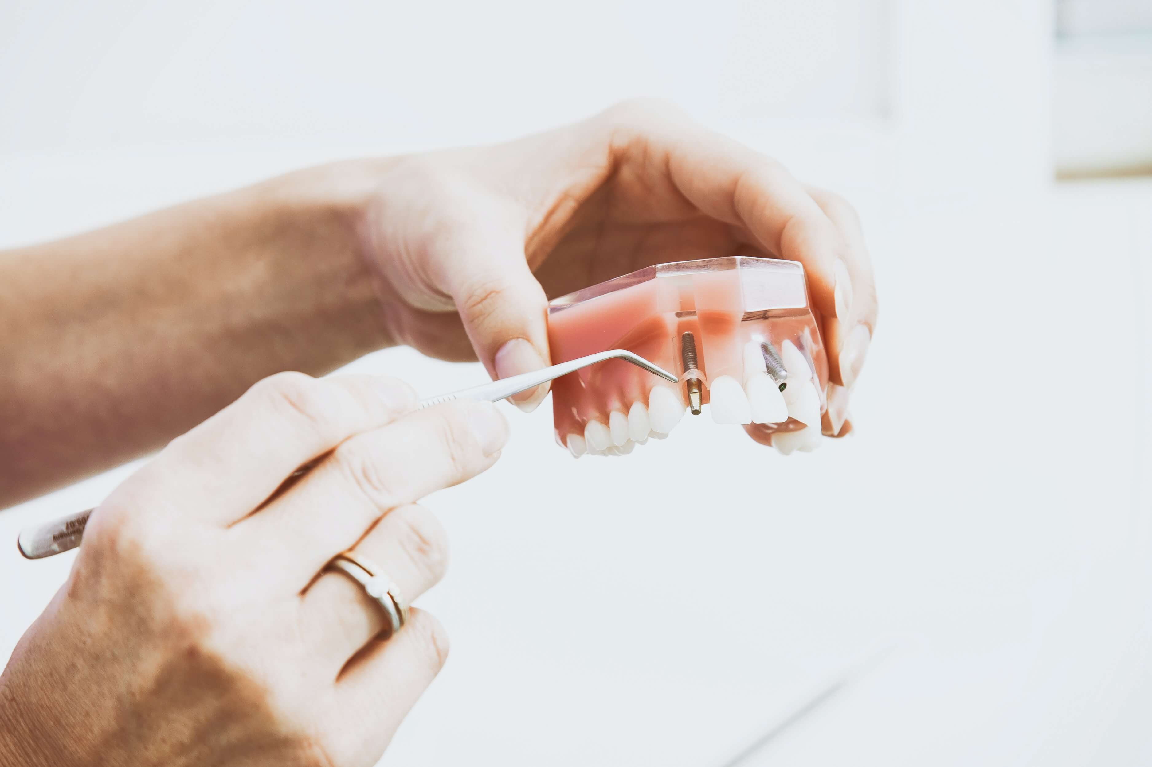 jak dbać o implanty zębowe